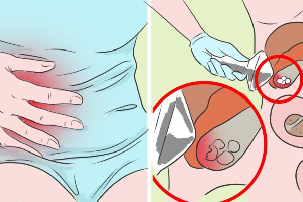 Всего 4 дней достаточно, чтобы вывести камни из желчного пузыря! Проверенный метод…