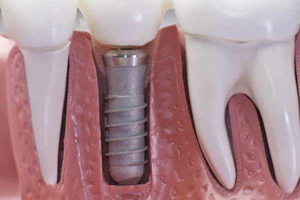 Стоматологи-эксперты: «Почему нельзя чистить зубы сразу после завтрака? Опасность в том, что…»