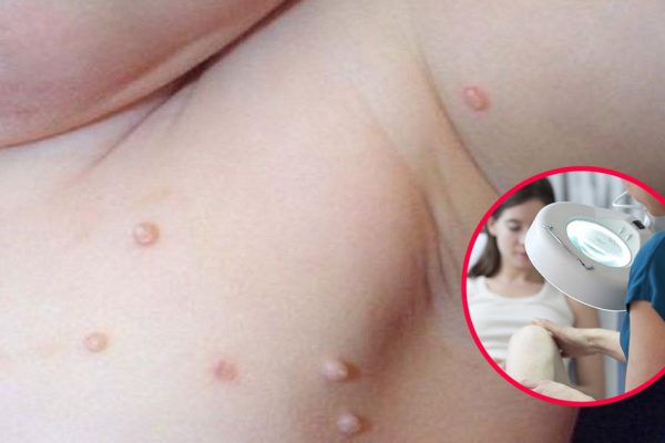 Заметила у племянника странные высыпания по всему телу… Оказалось, это папулы контагиозного моллюска!