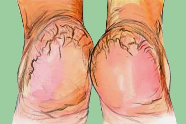 Крем «Безупречные пяточки»: такого ты не найдешь ни в одном магазине!