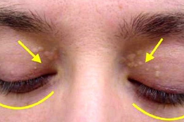 Повод беспокоиться! Заметив такие наросты, нужно сделать одну процедуру…