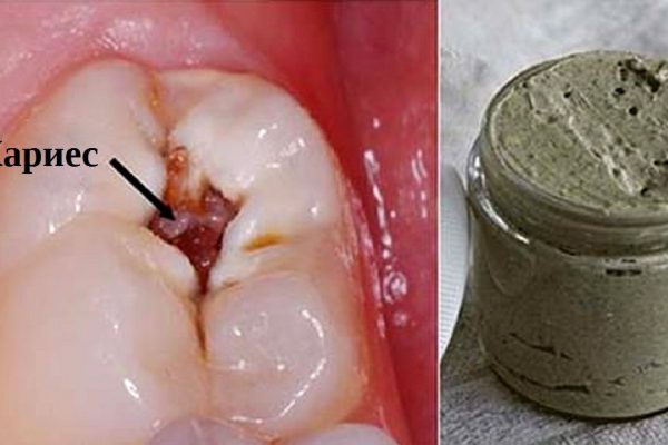 Домашняя паста для лечения кариеса, укрепления десен и отбеливания зубов.