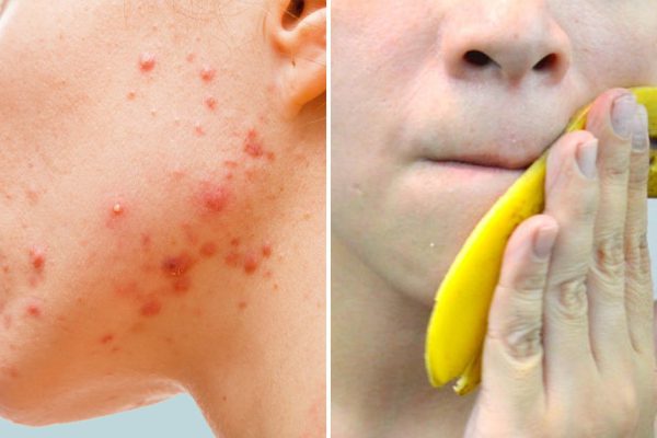 Вот что банановая кожура может сделать с твоей кожей: эффективней средства я не встречал!