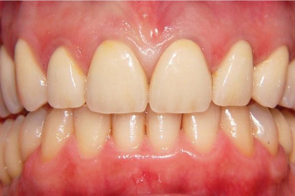 Это натуральное средство помогло вылечить опущение десен. Никакого дискомфорта уже после 3 дней применения!