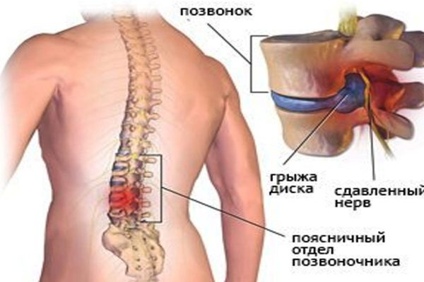 Как вылечить межпозвоночную грыжу без скальпеля! Всей семьей отговорили дядю от операции…