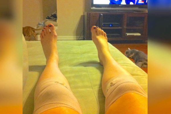 Она приложила этот компресс и туго обмотала колени! Спустя час ее жизнь изменилась…