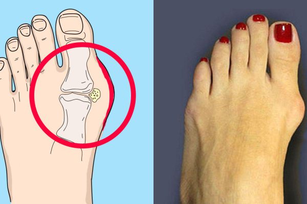 8 натуральных средств, которые помогут вылечить косточку на ноге. Боль уже прошла!
