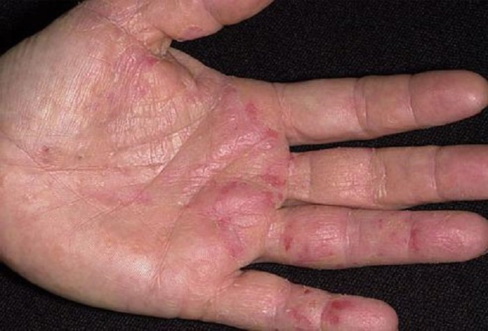 лечение кожных заболеваний имбирем