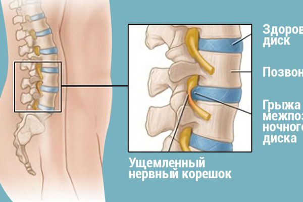 Хирург отговорил дядю от операции, посоветовав делать ЭТИ упражнения… Спустя полгода результат!