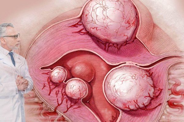 «Когда гинеколог сообщает о кисте или миоме, я пью всё это, и проблемы растворяются за 4 дня!»