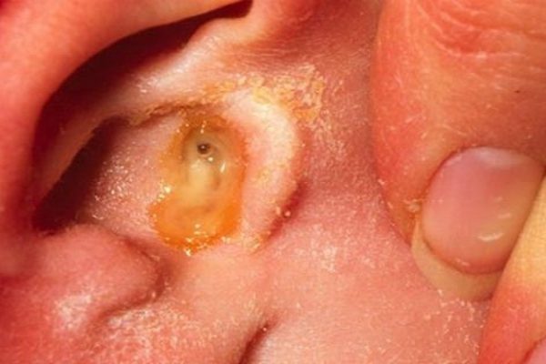 Попрощайся с инфекцией в ухе! Вот как легко избавиться от проблемы всего за 1 день.