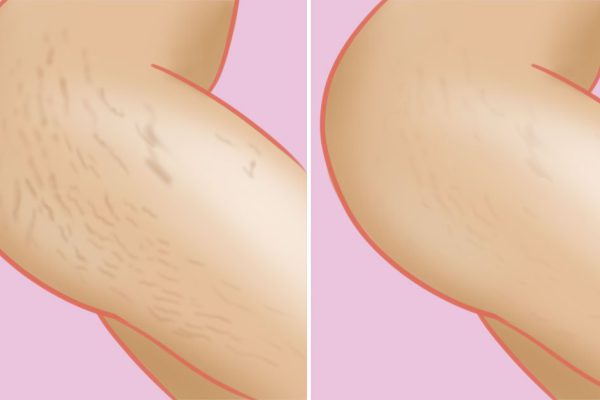 Подруга наносила это средство 3 раза в неделю… Эффект превысил все ожидания!