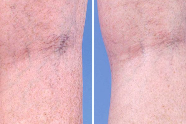 5 советов, которые помогут избавиться от сосудистых звездочек. № 2 прочно вошел в мою жизнь!