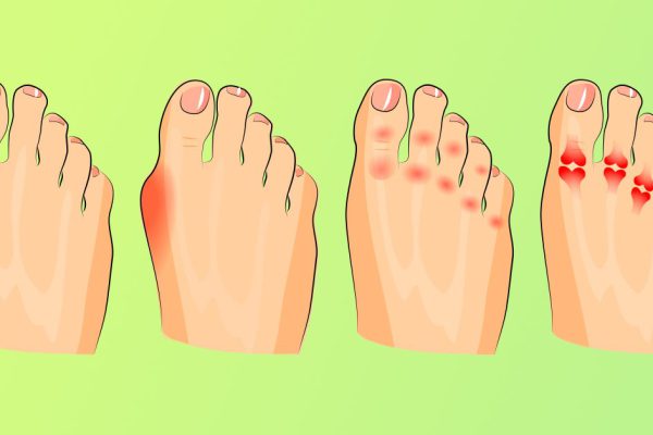 Избавься от боли в суставах в два счета: чудодейственная настойка от серьезной проблемы.