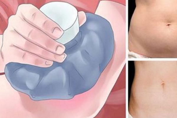 Как сжечь лишний жир при помощи льда. Удивительный метод, который действительно работает!