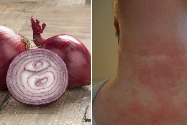Он приложил луковый компресс на ночь, а утром был крайне удивлен результату!