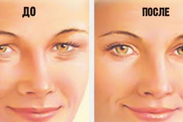 Вот как можно подтянуть обвисшую кожу век: 4 простых шага. Я уже попробовала!