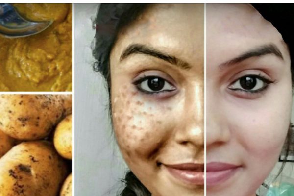 Ей понадобилось 7 дней и немного картошки — идеальная кожа и ни копейки за химию!