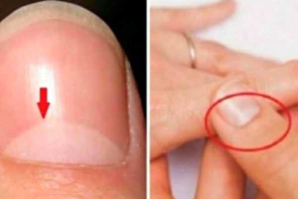 Вот почему могут исчезнуть белые лунки у основания ногтя: не пропусти тревожный симптом!