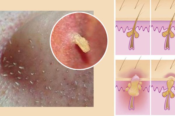 Средство из 3 ингредиентов, после которого ты не узнаешь свою кожу. Шикарное действие!