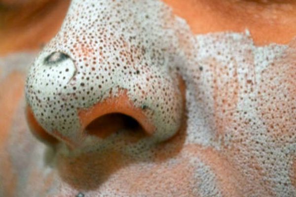 Глина против черных точек: очищающие маски, которые избавят от дефектов кожи!