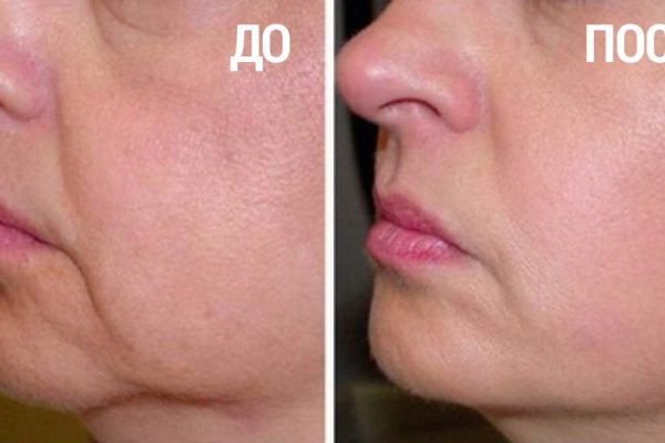 Средство против морщин № 1, которое есть дома у каждого! Больше никакой обвисшей кожи…