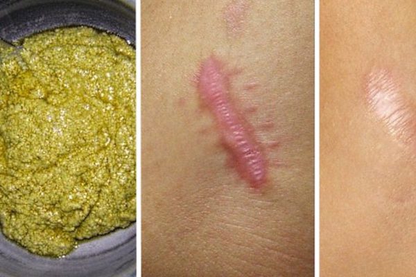 Это народное средство избавит тебя от шрамов и растяжек всего за 2 месяца!