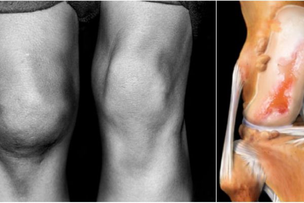 Подруга потратила две зарплаты, чтобы вылечить колени. Лишь это простое средство остановило артроз!