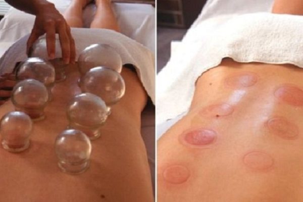 Вот почему тебе срочно необходима каппинг-терапия!