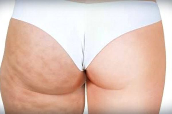 Самое доступное средство против целлюлита! Всего 1 продукт избавит тебя от назойливой проблемы…