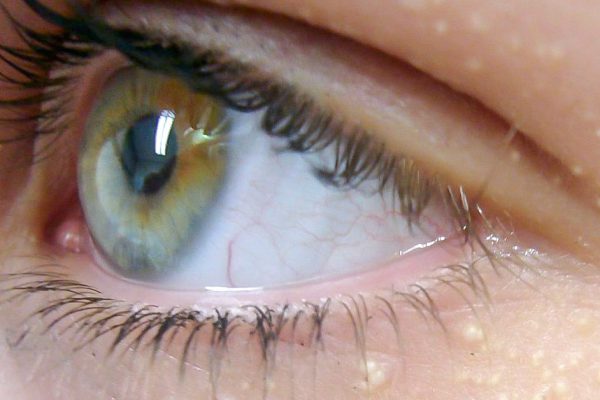 Ты даже не представляешь, о чём свидетельствует появление белых точек вокруг глаз!