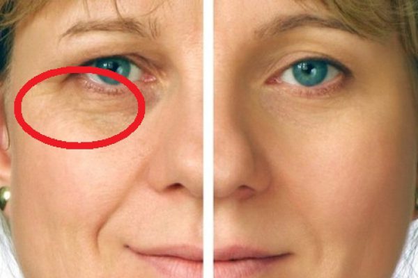 Узнай, какие ингредиенты нужно смешивать для маски от мимических морщин. 4 суперрецепта!