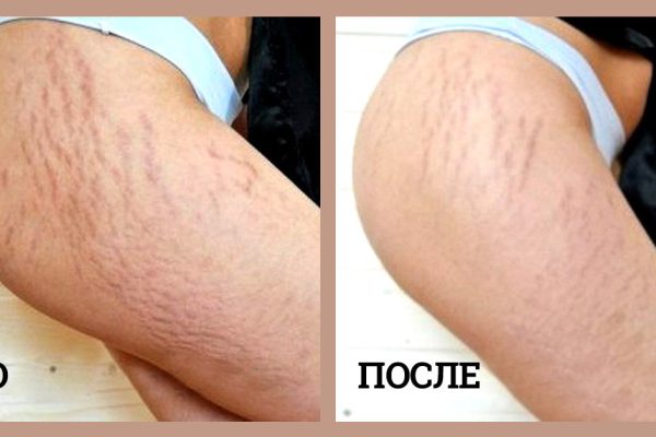 Мумие от растяжек и не только: чудодейственные свойства древнейшего средства.