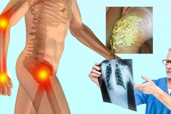 Закарпатский рецепт от боли в суставах! Необходимо на сухую…