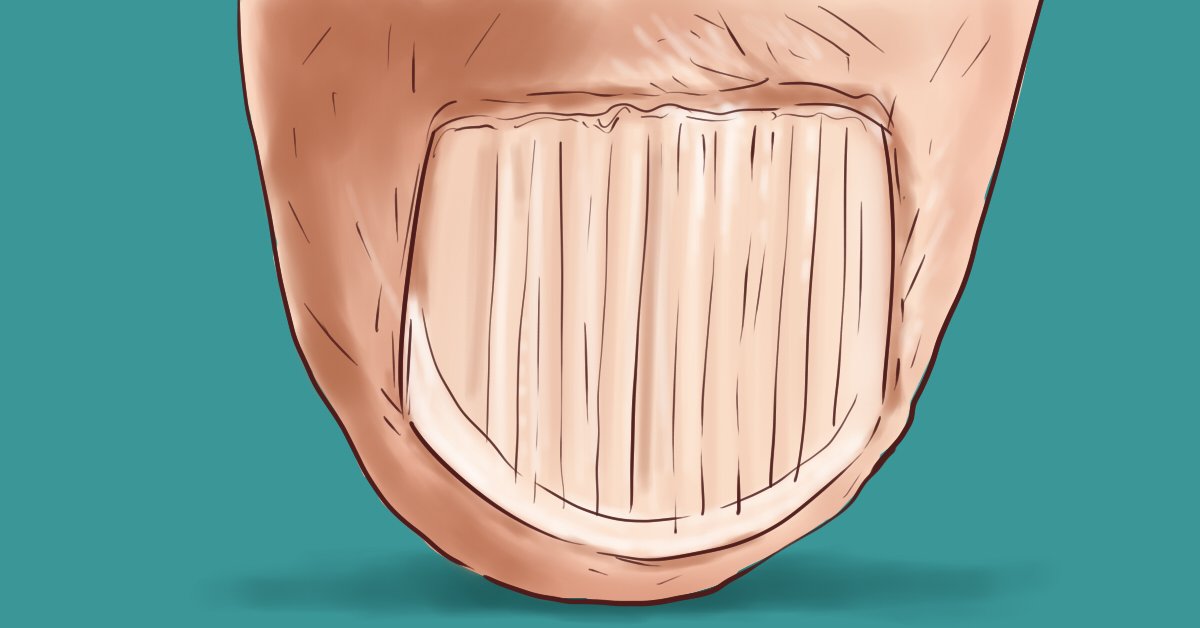 Недостаток белка