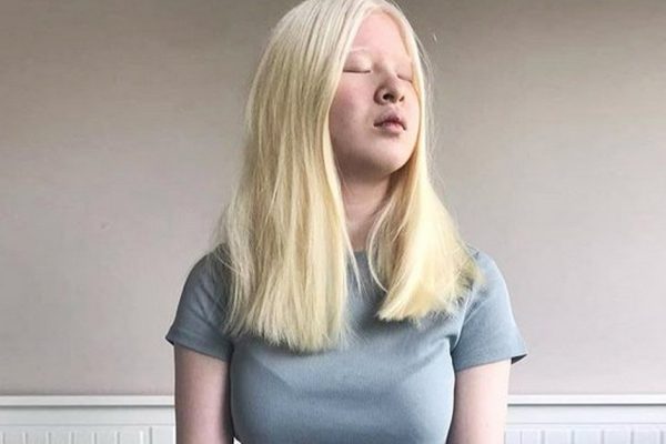 Родители выбросили малышку, а девочка выросла и стала моделью Vogue