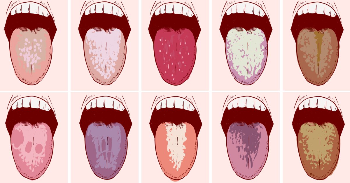 Признаком каких патологий является кислый привкус во рту?