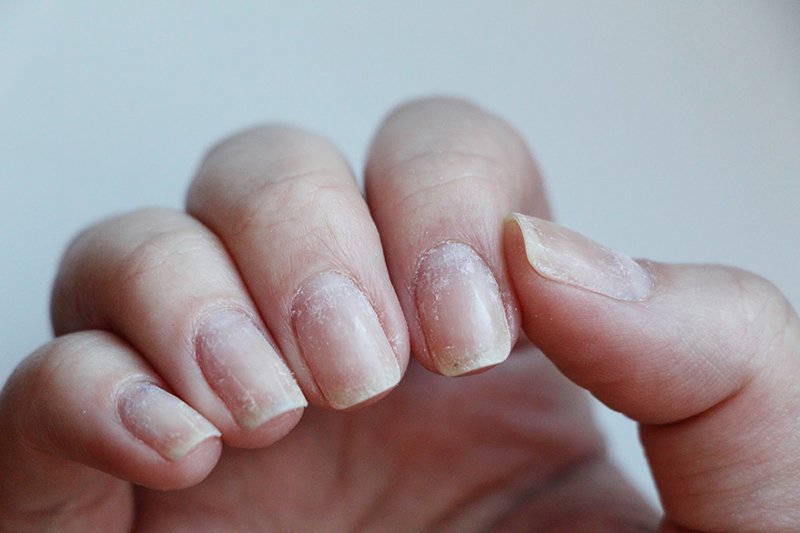 как восстановить ногти после шеллака
