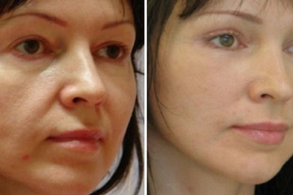 Обвисшие щеки? Узнай о действенных методах коррекции лица!