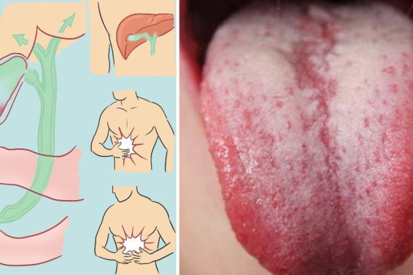 Немедленно прочти эту статью, если заметил такой же налет у себя на языке!