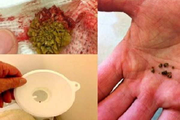 Только посмотри, как камни выходят из почек с помощью этого натурального средства!