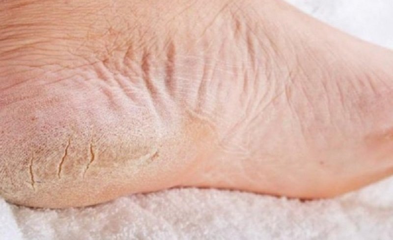 Ako odstrániť hrubej kože na nohách doma