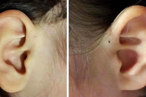 Угроза для здоровья! Вот почему у некоторых людей есть такая дырочка в ухе.