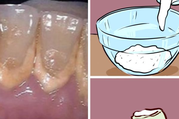 Походы к стоматологу ей больше не нужны! Всего 1 бумажная пачка из аптеки, за смешную цену…