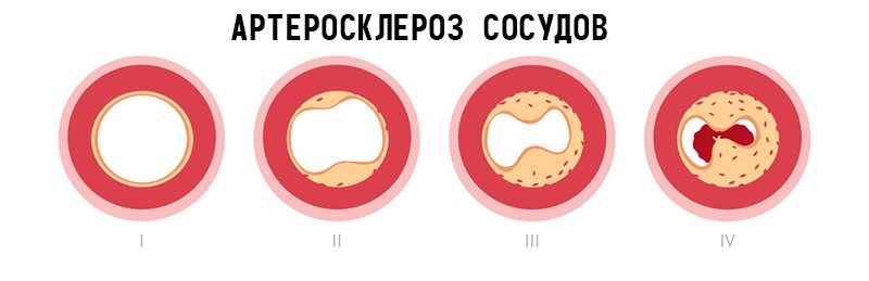 острые нарушения кровообращения