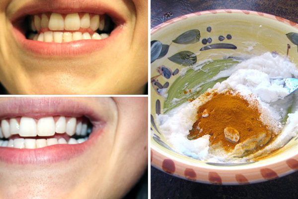 Причина улыбаться почаще: натуральное средство из куркумы для качественного отбеливания зубов!