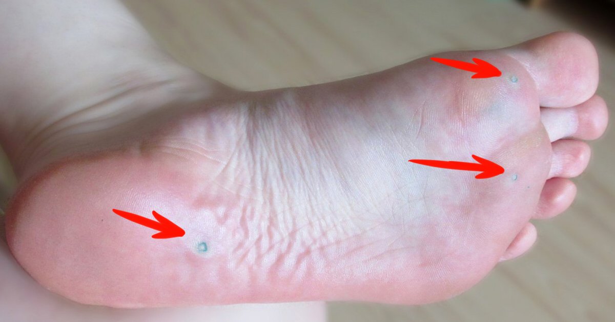 Папилломавирус человека