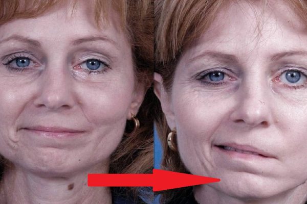 Твое тело предупреждает: 8 сигналов об инсульте в скором времени. Запомни!