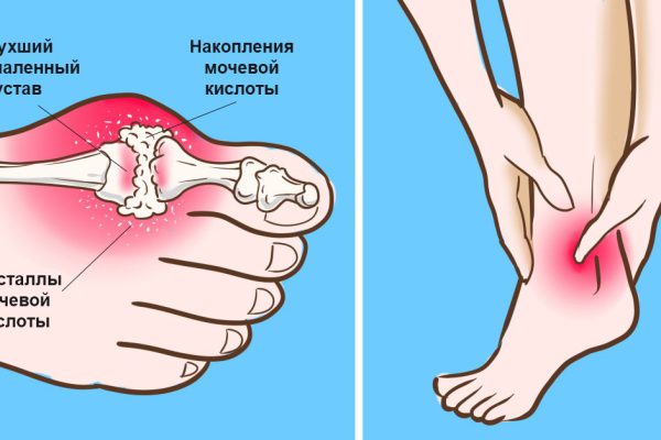 Снижение уровня мочевой кислоты: артрит отступит в одно мгновение, если добавить в свой рацион…