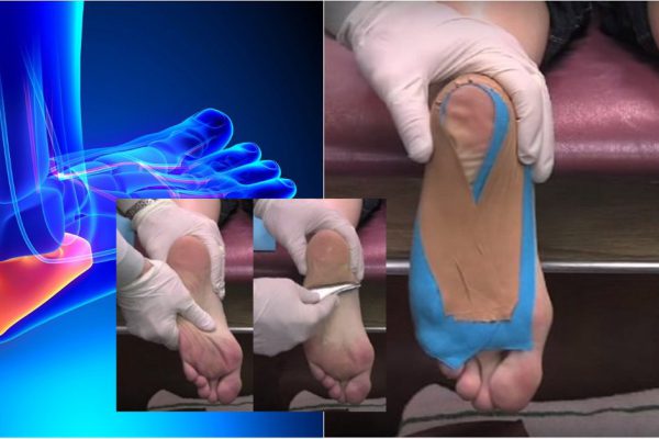 Женщина не обращала внимание на боль в пятке, а оказался плантарный фасциит… Лечить немедленно!